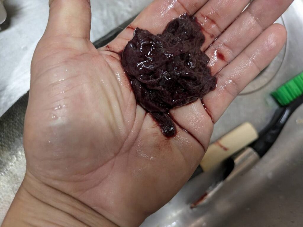 取り除いた腎臓（めふん）の画像
