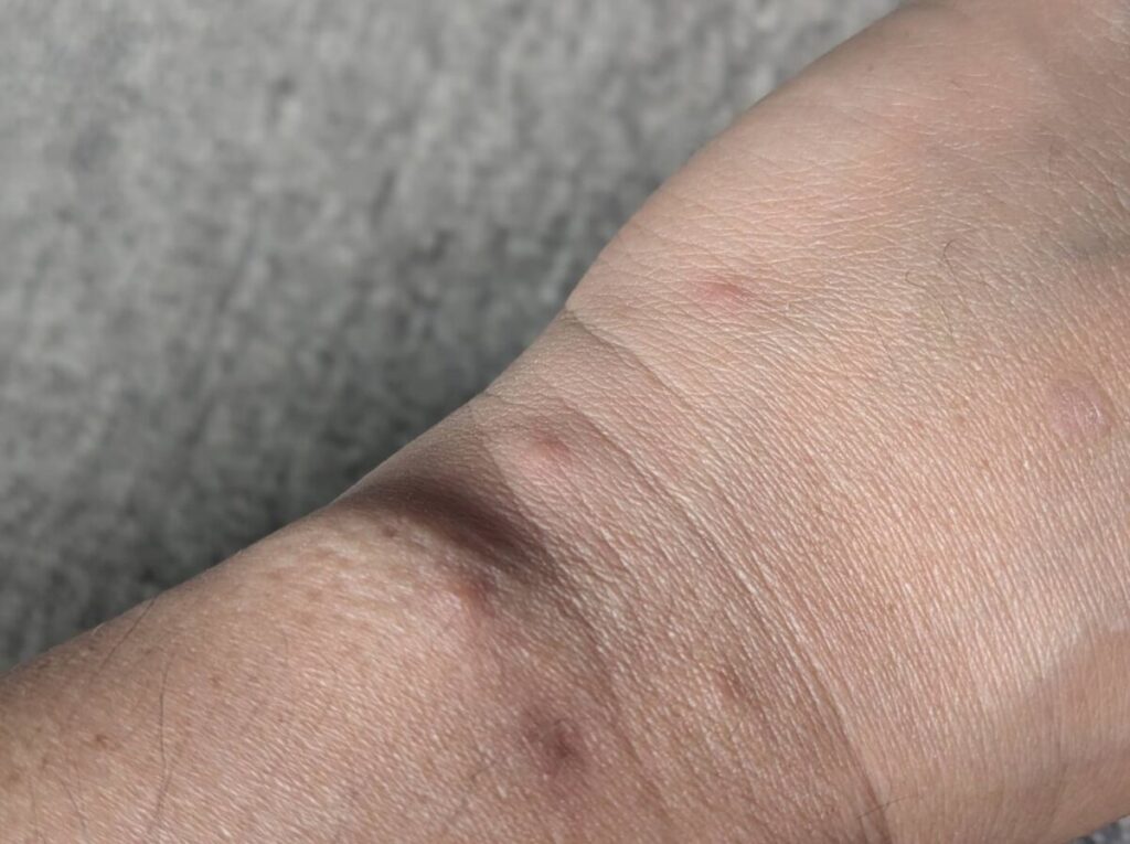 蚊に刺された筆者の腕